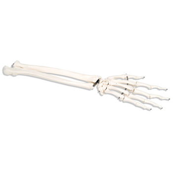 手骨骼(带有部分尺骨和桡骨)不锈钢丝紧连(右)