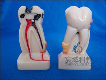 CY-KQ042 4倍牙体综合病理模型