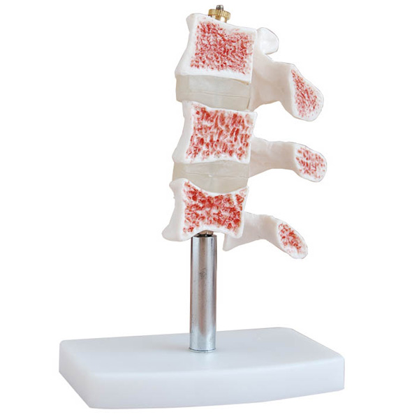 CY-XC134 骨质疏松模型(脊椎典型病变模型)