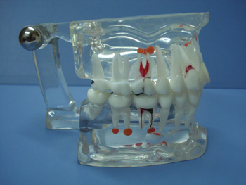 CY-KQ010 综合病理水晶牙列模型(可拆)