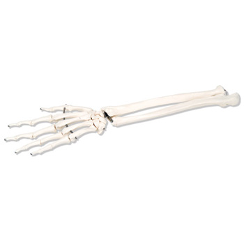 手骨骼(带有部分尺骨和桡骨)不锈钢丝紧连(左)