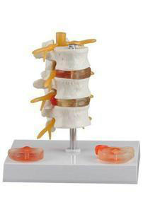3节腰椎附2个病变椎间盘模型
