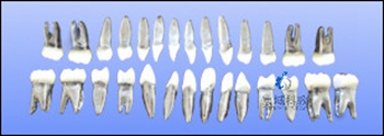金属根树脂冠恒牙模型