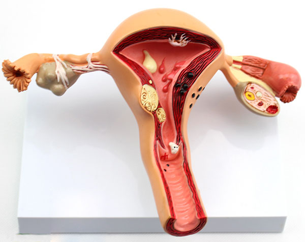 子宫、卵巢病理模型